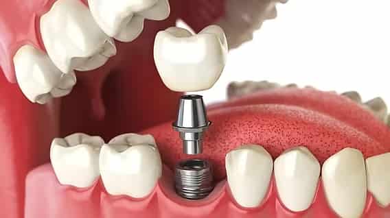 Implantes dentales: precios, riesgos y opciones más seguras en 2025